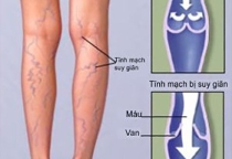 TƯ VẤN SUY GIÃN TĨNH MẠCH, NÔNG SÂU CHI DƯỚI 