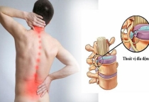 Biến chứng của thoát vị đĩa đệm cột sống thắt lưng