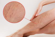 CÁCH ĐIỀU TRỊ BỆNH GIÃN TĨNH MẠCH CHÂN TỐT NHẤT HIỆN NAY