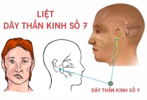 KHÓA HỌC XBBH - VLTL Hỗ trợ hệ thần kinh số 7 liệt 1/2 cơ mặt
