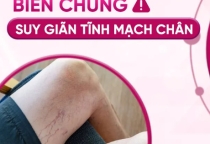 NHỮNG BIẾN CHỨNG SUY GIÃN TĨNH MẠCH CHÂN  GÂY RA