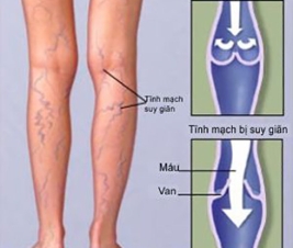 TƯ VẤN SUY GIÃN TĨNH MẠCH, NÔNG SÂU CHI DƯỚI 
