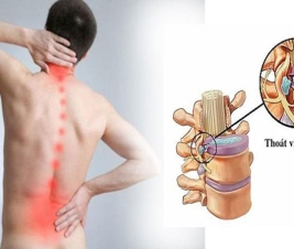 Biến chứng của thoát vị đĩa đệm cột sống thắt lưng
