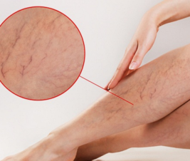 CÁCH ĐIỀU TRỊ BỆNH GIÃN TĨNH MẠCH CHÂN TỐT NHẤT HIỆN NAY