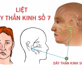 KHÓA HỌC XBBH - VLTL Hỗ trợ hệ thần kinh số 7 liệt 1/2 cơ mặt