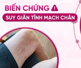 NHỮNG BIẾN CHỨNG SUY GIÃN TĨNH MẠCH CHÂN  GÂY RA