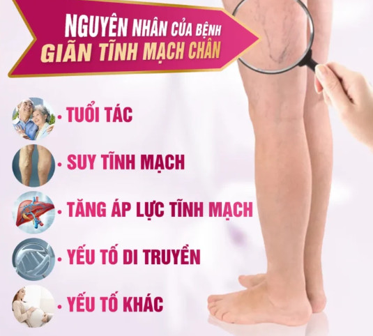 Nguyên nhân của bệnh giãn tĩnh mạch chân 
