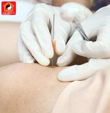 XBBH-VLTL cấy chỉ cắt gút hàn quốc 