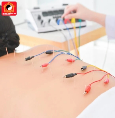 XBBH - VLTL điện xung các cơ khớp,  châm cứu